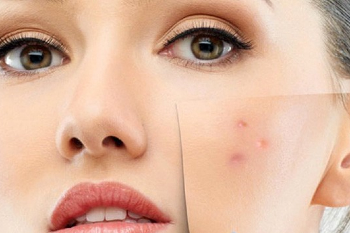 Hassas ve alerjik ciltlere mevsim geçişlerinde dikkat