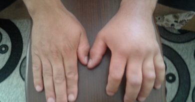 Türkiye’de tanınmayan hastalık: Alerji mi, Herediter Anjiyoödem mi?