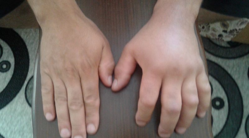 Türkiye’de tanınmayan hastalık: Alerji mi, Herediter Anjiyoödem mi?