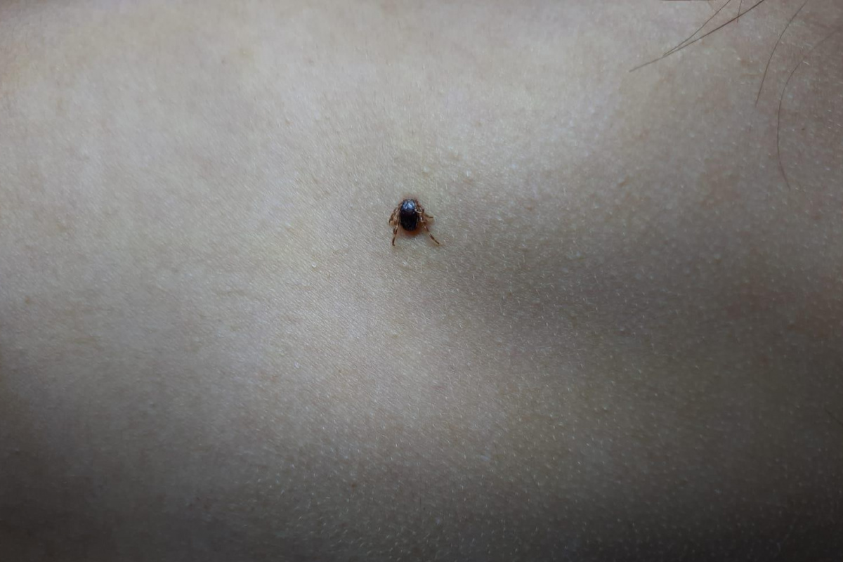 Çocuğun sırtındaki kene hastanede çıkartıldı