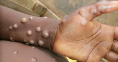 Maymun Çiçeği nedir? Maymun Çiceği belirtileri neler!