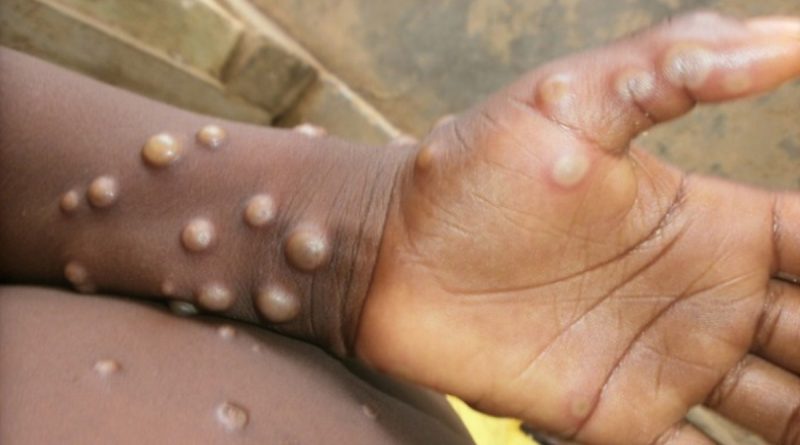 Maymun Çiçeği nedir? Maymun Çiceği belirtileri neler!